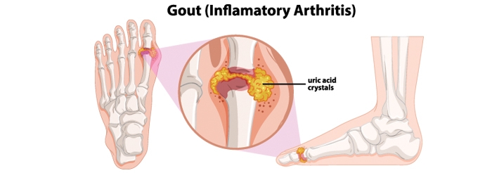 Hiểu đúng về bệnh gút (gout)